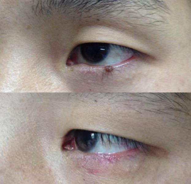 起痣是用药好还是用激光好,点长毛的痣需要手术还是激光