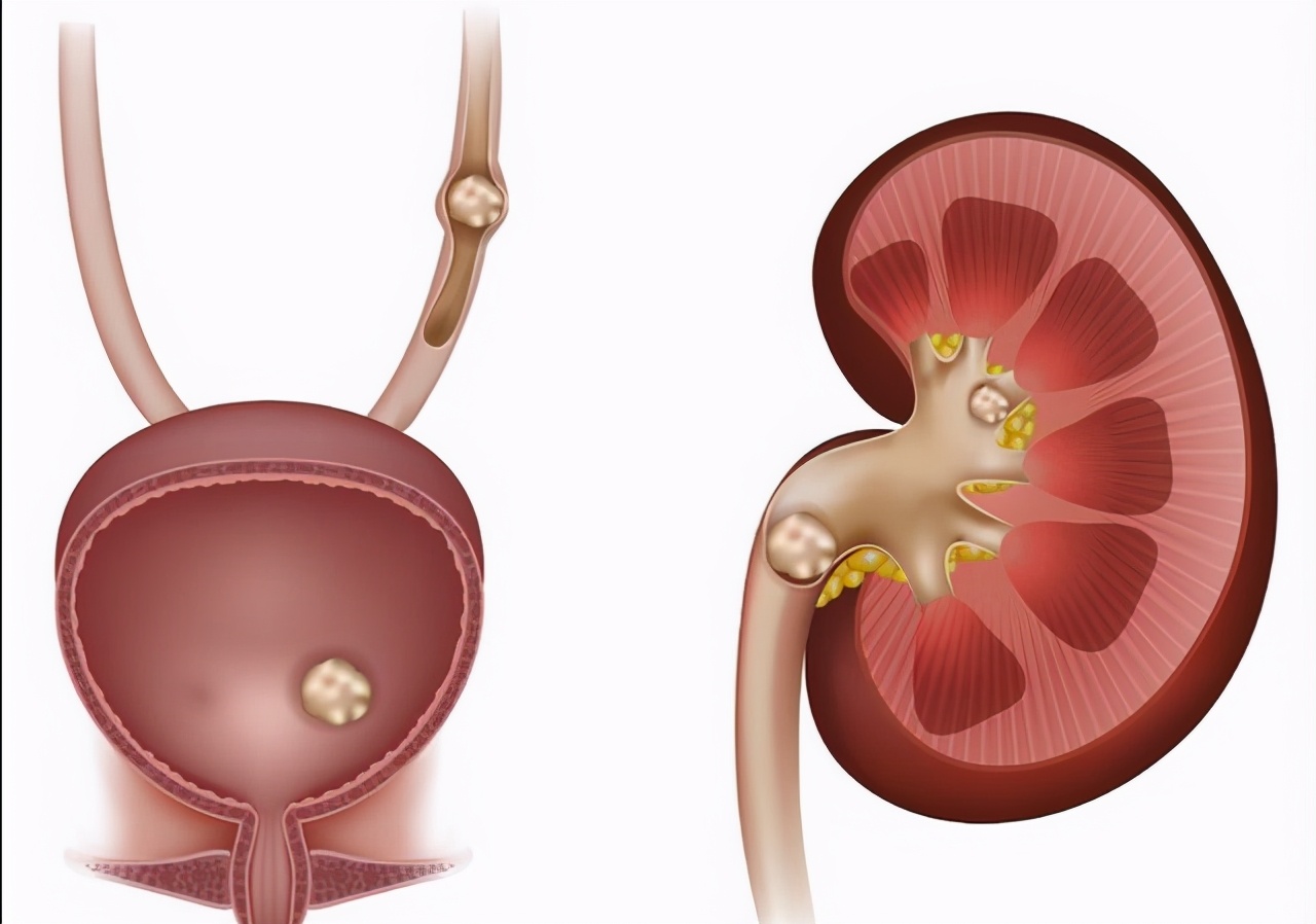 体检查出有肾结石要注意什么,查出有肾结石要注意什么