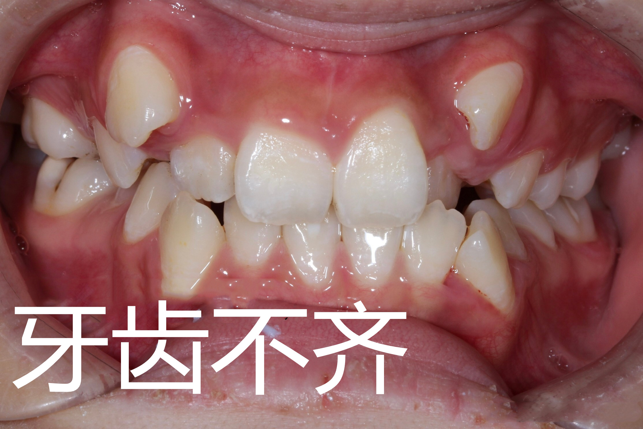 30岁了还可以做牙齿矫正吗,30岁还可以做牙齿矫正吗