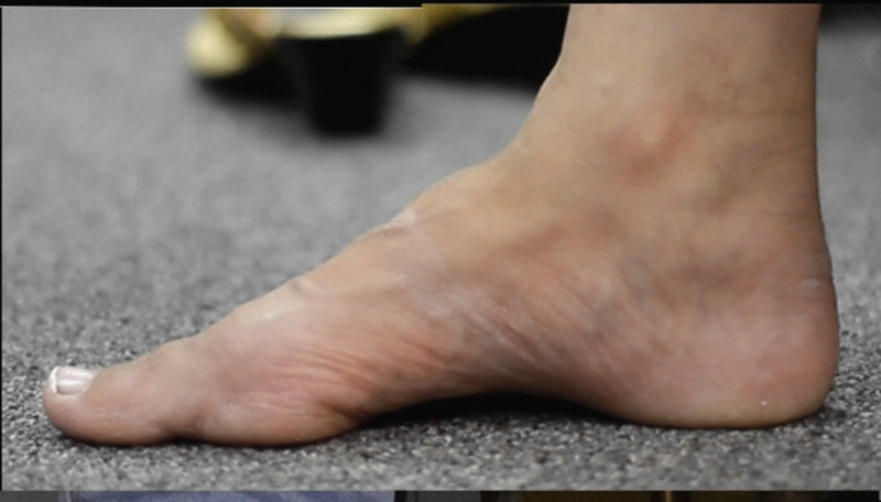 为什么最近突然觉得脚变大了,脚突然变大了怎么回事