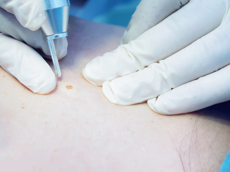 怎么判断身上有痣还是黑色素瘤,身上的痣怎么判断是黑色素瘤