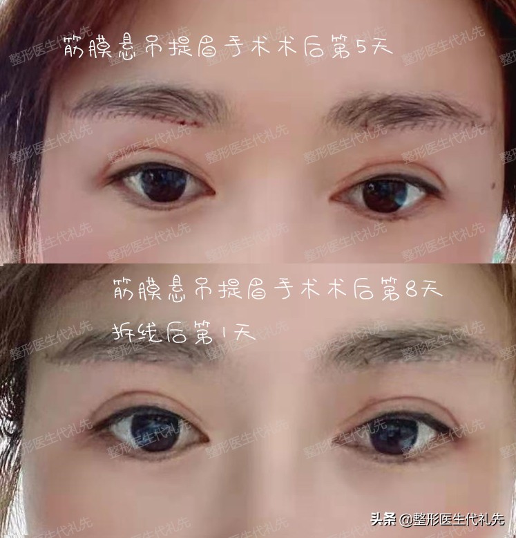 做提眉之前需要注意什么,提眉手术怎么操作