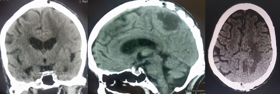 陕西102岁老人手术成功,医生切除77岁老人多个无病脏器