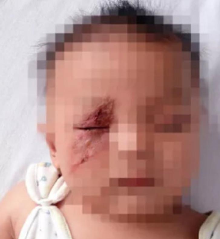 幼儿被隐翅虫弄到怎么处理,家里有婴儿怎么处理隐翅虫