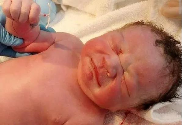 遗留在妈妈体内的节育环,钉在子宫壁上的节育环