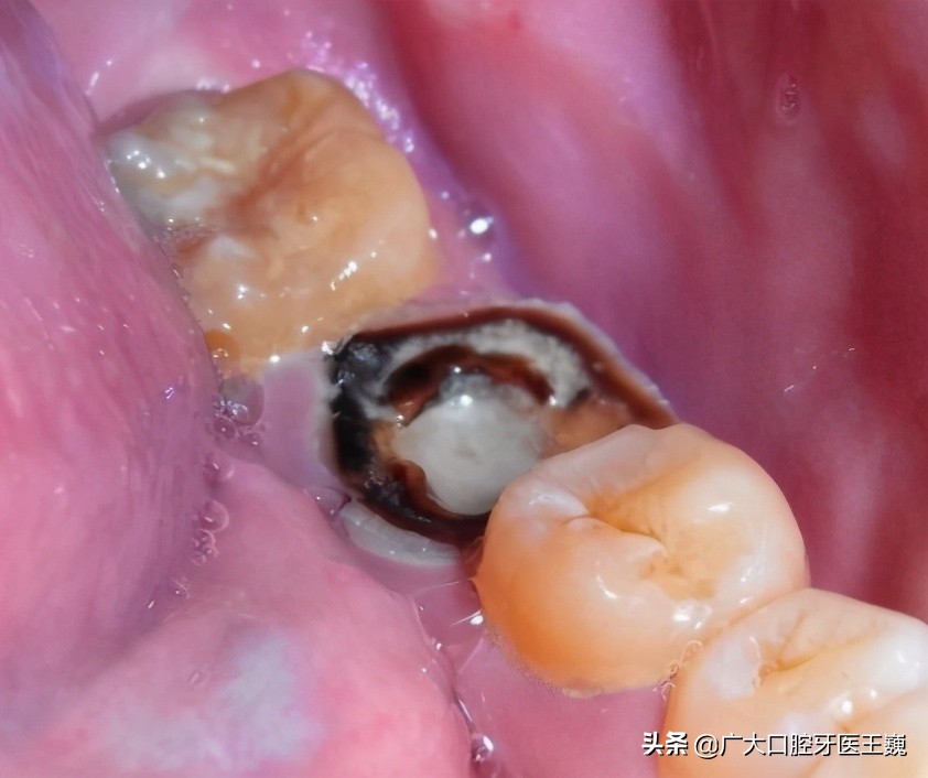 最里面烂牙残根不拔的危害大吗,成人烂牙残根不拔的危害大吗