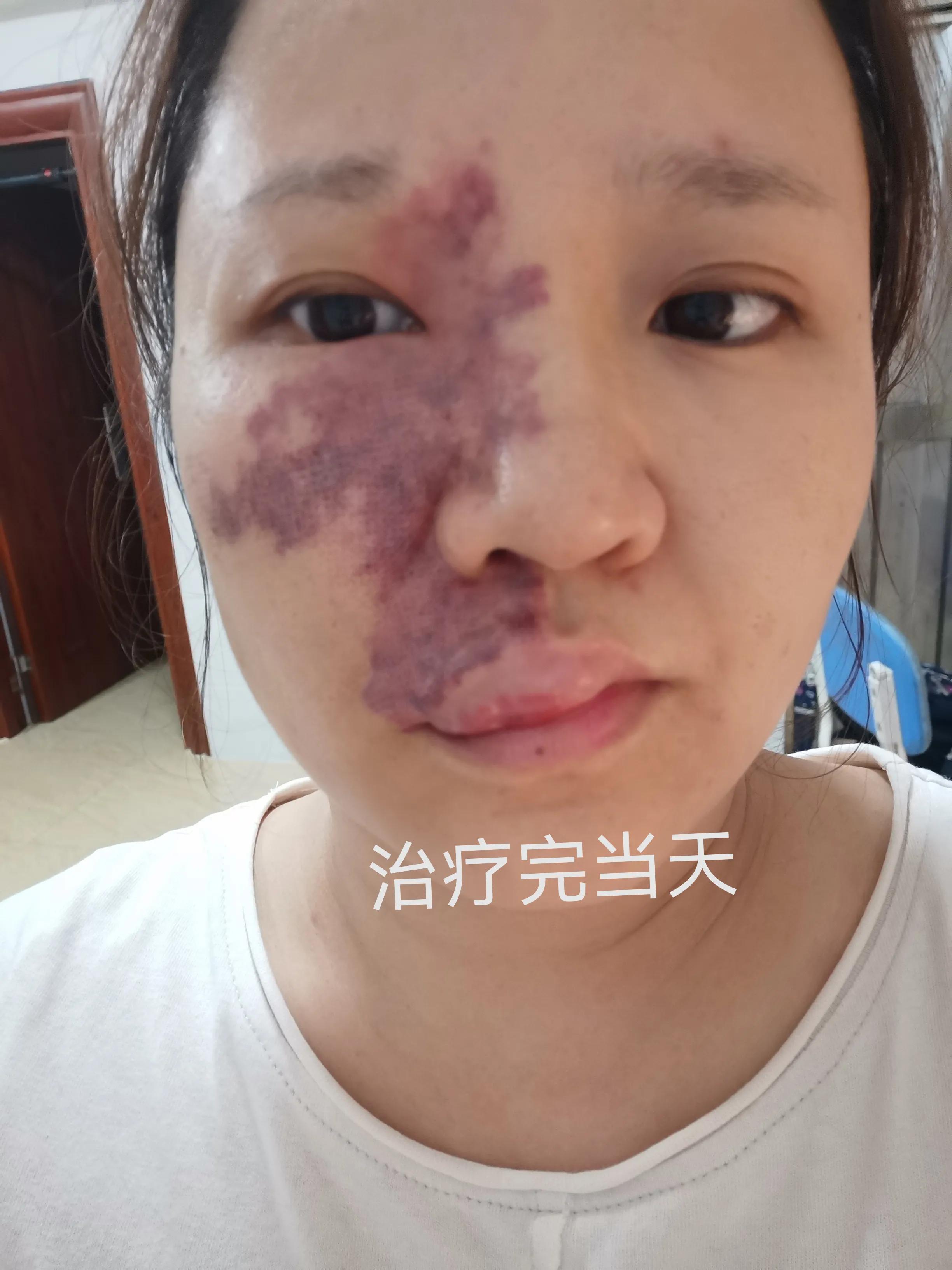 记录一下这次鲜红斑痣治疗经过