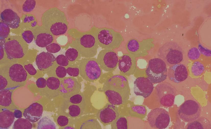 白血病和血癌是突然就有的吗,白血病的发病率在癌症中占第几