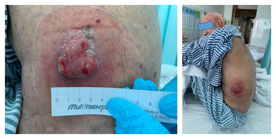 光动力肿瘤治疗进展,光动力治疗能完全去除肿瘤吗