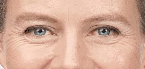 鱼尾纹法令纹抬头纹显老又难看,法令纹鱼尾纹抬头纹哪个最难看