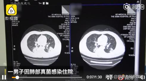 臭袜子真菌感染,一双臭袜子引发的惨剧