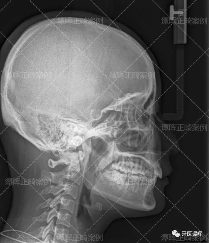 门牙前突牙齿不齐矫正案例分享,门牙和旁边牙齿不齐最快矫正方法