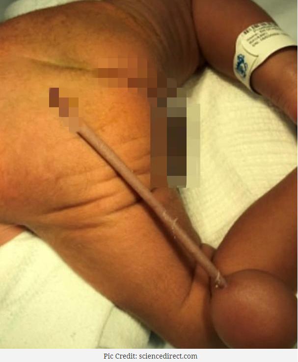 母亲孕期每天10支烟，巴西男婴出生时竟长“尾巴”