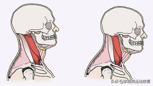 一招解决颈后大包,纠正颈后大包练哪些肌肉