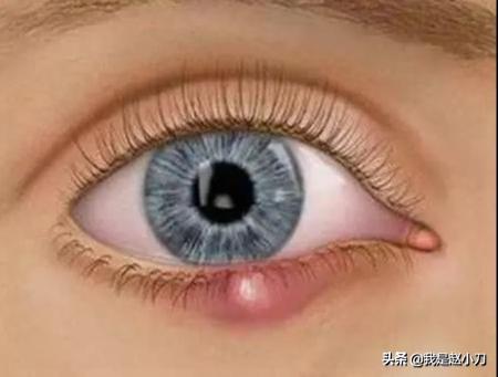 麦粒肿怎么治疗用什么眼药水治疗,麦粒肿可以用多久治愈