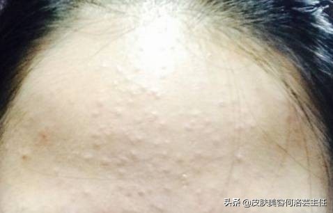 疮疡病的症状及治疗方法,生疮的症状和治疗方法