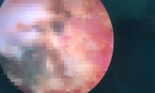 小孩鼻子塞进异物出血怎么处理,小孩耳朵塞进异物流血