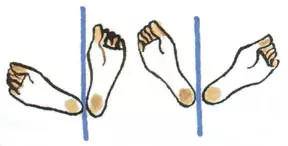 跷二郎腿骨盆倾斜可以正骨吗,跷二郎腿骨盆倾斜矫正