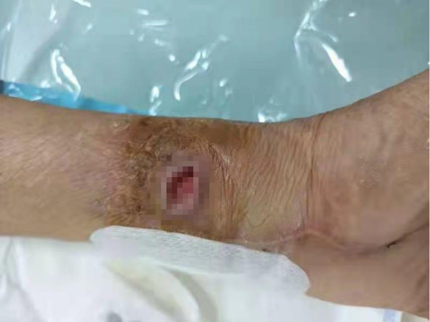 钓鱼饵料引起手上起泡脱皮开裂,钓鱼饵料导致手严重脱皮怎么办