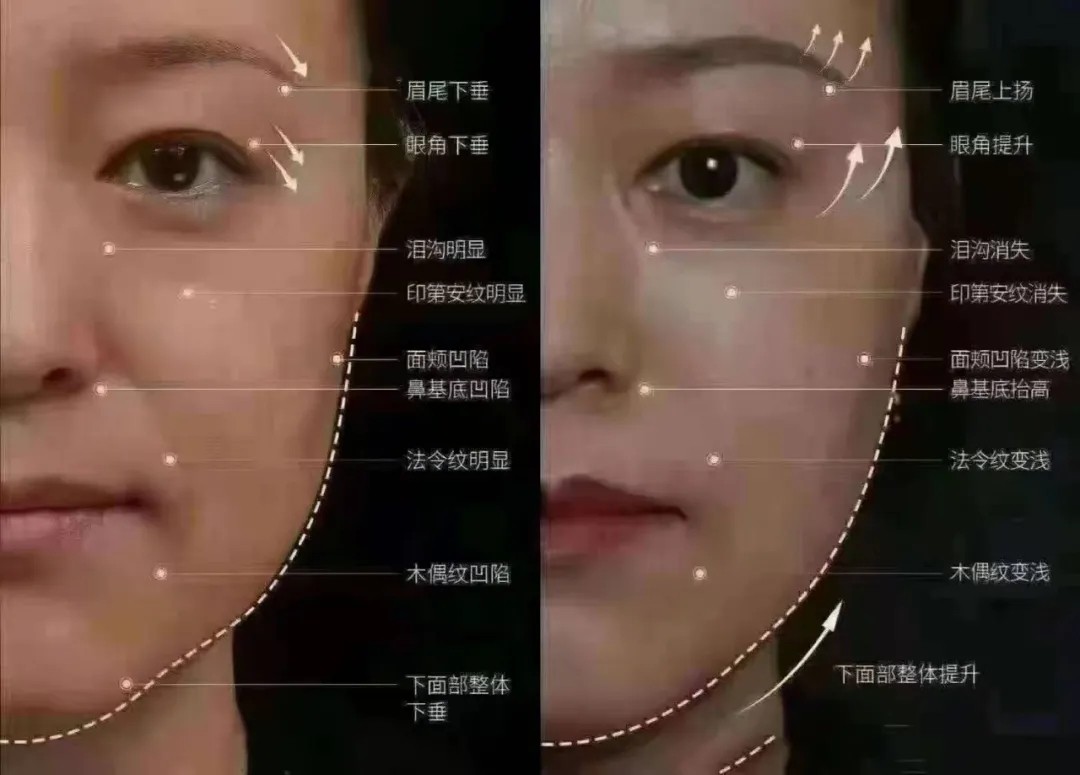 7d聚拉提和热玛吉超声刀哪个贵,热玛吉和超声刀7d哪个提拉效果好