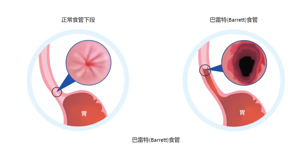 反流性食管炎是食管癌的前兆吗,反流性食管炎一直不好怎么办