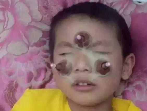 艾灸馆艾灸理疗师工作日常,儿童艾灸最佳时间和禁忌