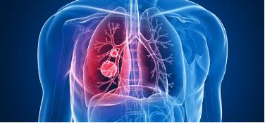 肺癌手术后多久能正常运动,肺癌术后运动好还是静养好