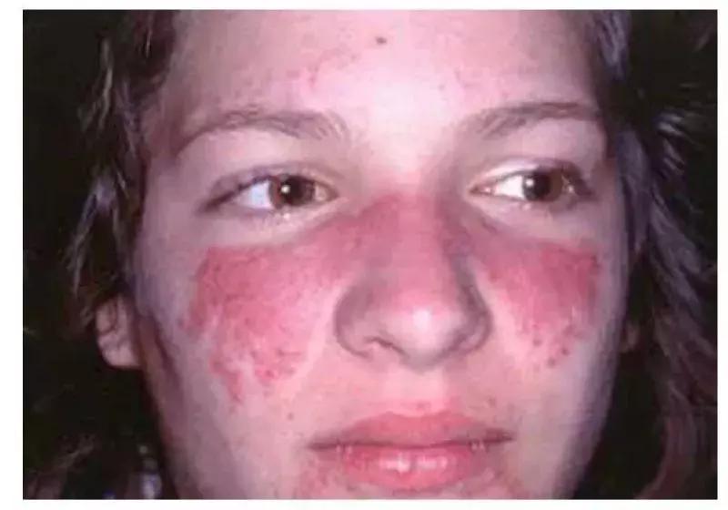 被屠呦呦团队盯上的红斑狼疮到底是什么病？致死但5年生存率达90%