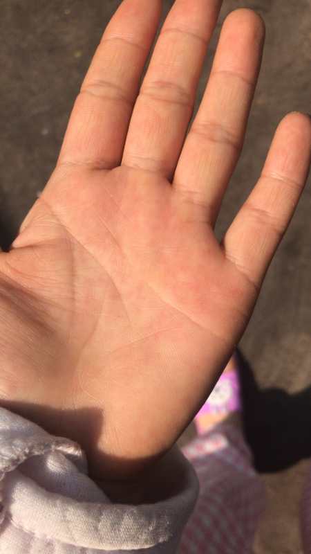 解决“水手”难题,水矿总医院成功治愈首例“手汗症”