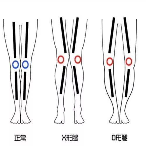 适用于所有腿型的腿型矫正方法,怎样矫正腿型让腿变得又细又直