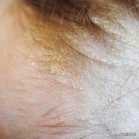 皮肤干燥脱皮10分钟清晨急救法,皮肤干燥尤其是秋冬会全身脱皮