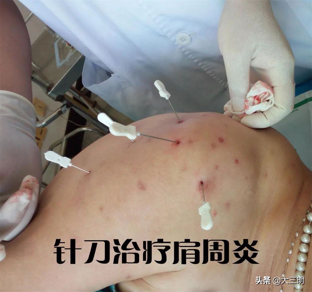 顽固性网球肘的敲打治疗,网球肘针刀效果怎么样