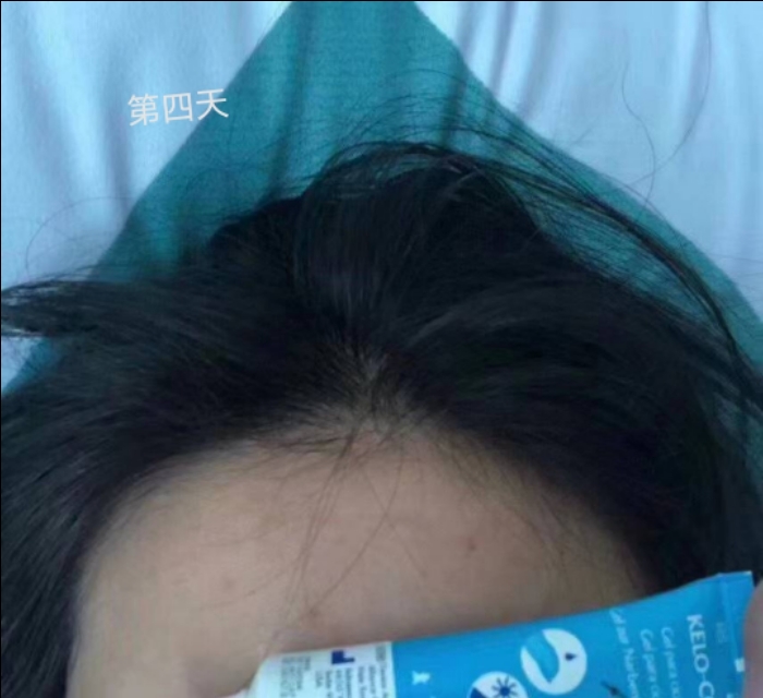 你用过最好的祛疤方法,小红书推荐祛疤真的有效吗