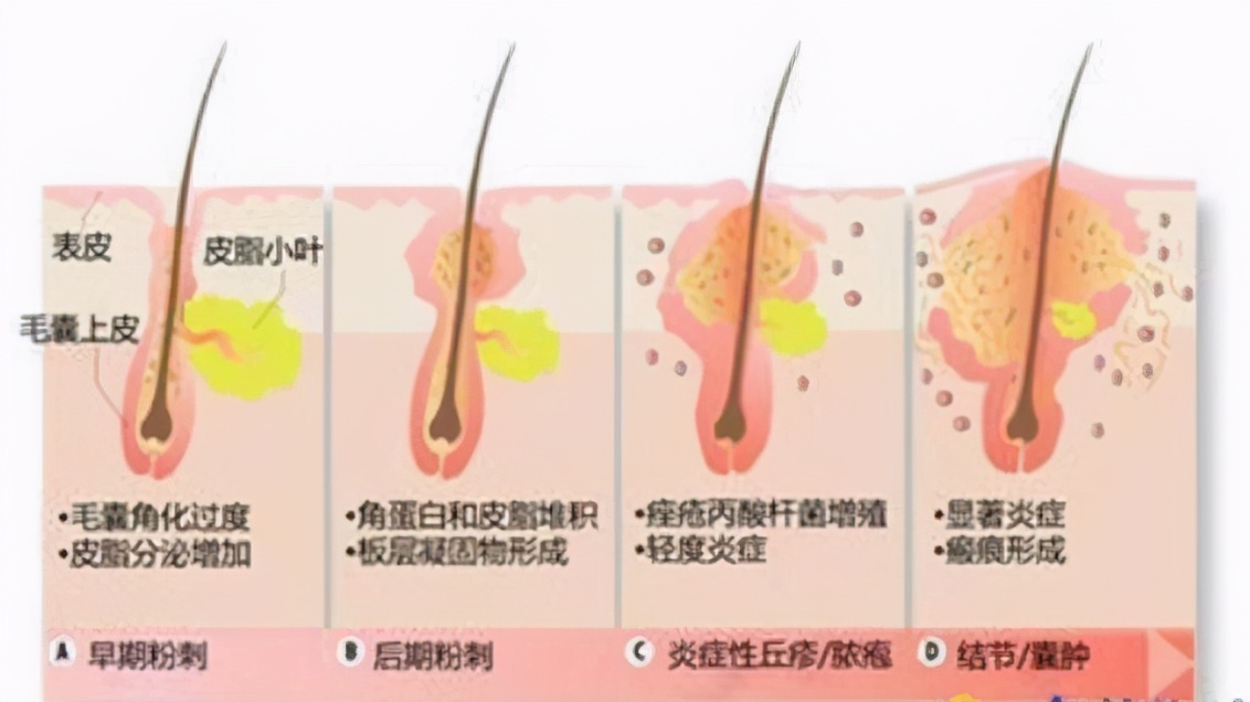 祛除痘坑痘印药膏,男士痘印痘坑怎么去除