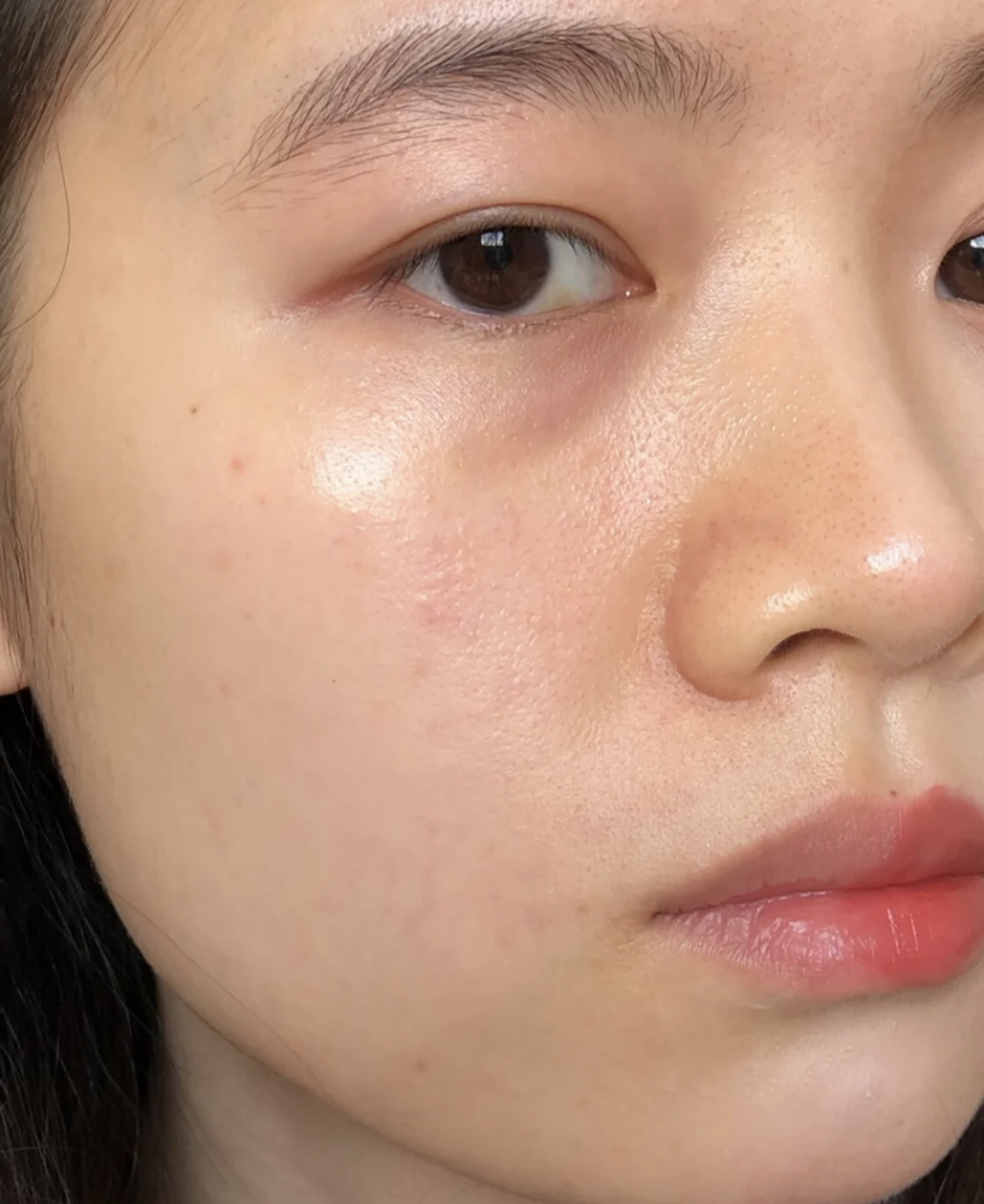 眼尾有皱纹怎么治疗,眼尾沟里面有皱纹怎么办