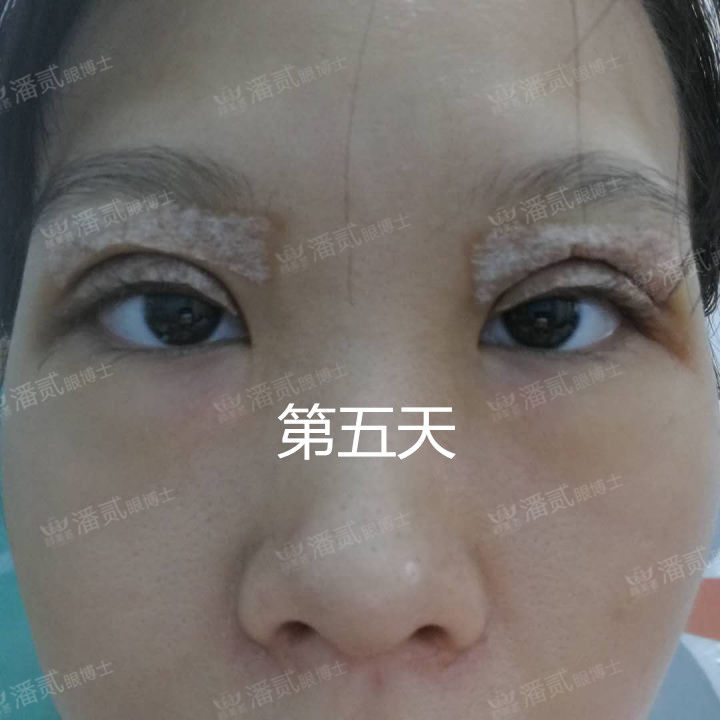 原来双眼皮不好看有必要继续割吗,割双眼皮是不是越修复越难看