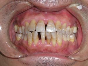 牙齿松了可以做补齿吗,牙松了用冷酸灵能固齿