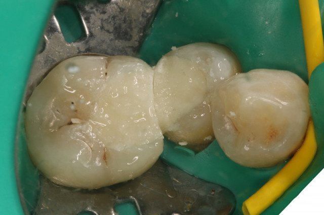 蛀牙补牙的材料基本就这些了,看你要怎么选