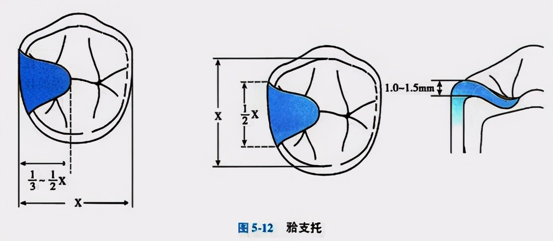 牙列缺损的可摘局部义齿修复题库,牙科美学修复精讲
