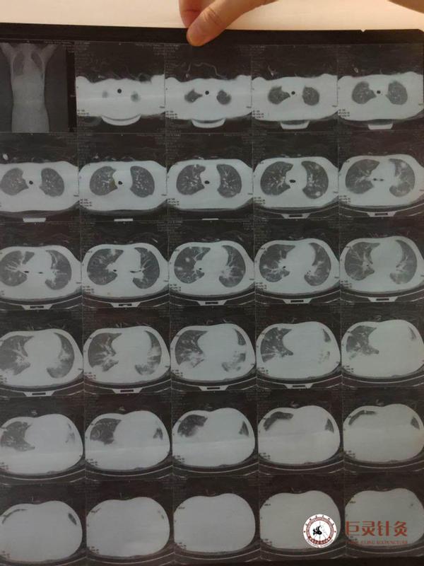 克隆恩氏病中医可以治疗吗,克隆恩氏病治疗费用