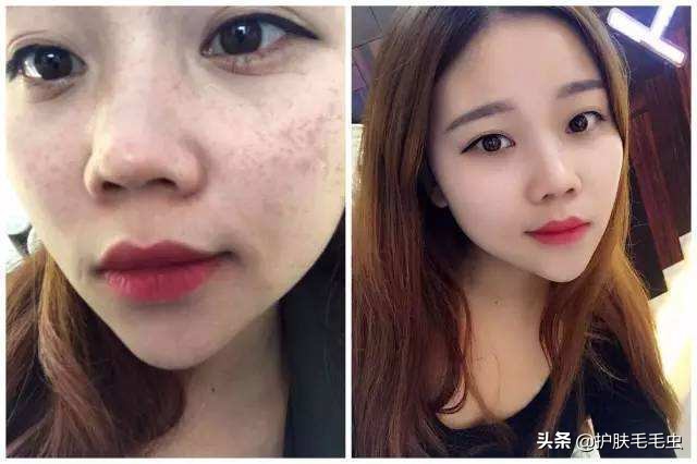 脸颊两侧长斑怎样祛除效果最佳,脸颊两边长斑最有效的淡化妙招