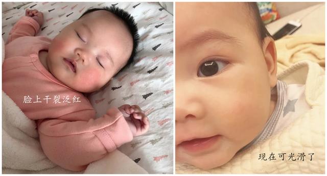 1岁半孩子湿疹反反复复怎么根除,孩子急性湿疹反复发作怎么根治