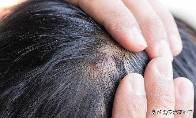 头皮长痘痘解决方法视频,头发油腻头皮长痘痘是什么原因