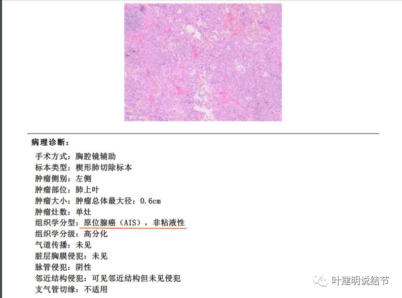 从活检怎么看是非小细胞癌,从病例谈辨证论治