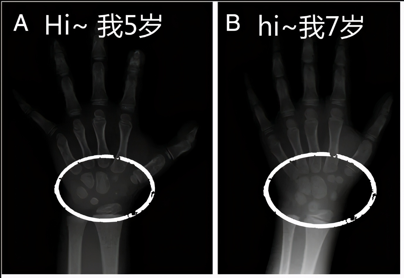宝宝骨龄测算小了一岁,宝宝测骨龄有什么危害