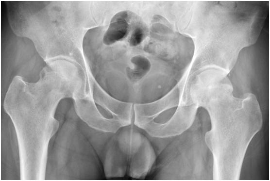 啤酒和白酒哪个对骨头伤害大,酒精对骨头的危害的视频