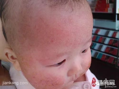 宝宝出现湿疹的原因和护理措施,高烧湿疹的症状及治疗方法
