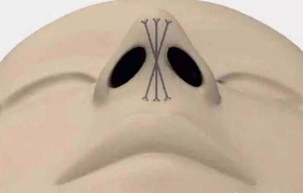 线雕隆鼻能维持几年还是那么挺,线雕隆鼻真的能吸收吗