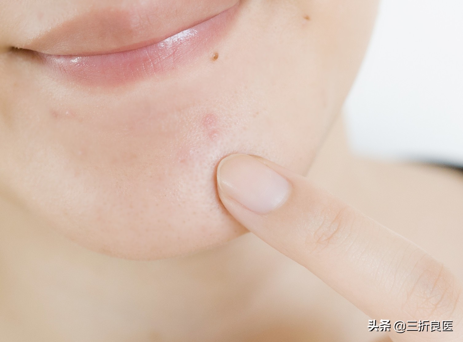 皮肤科医生针对痘印痘疤相关建议,皮肤科医生教你祛痘印