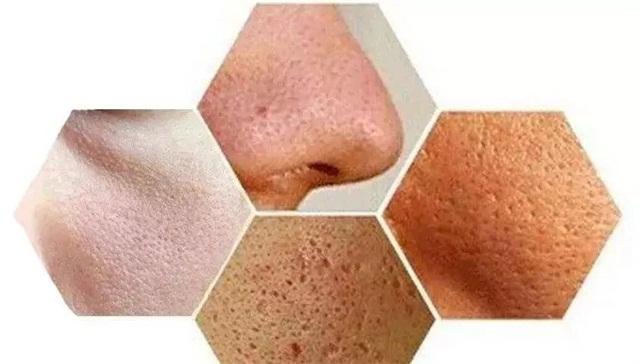 毛孔粗大皮肤粗糙怎么办,男生毛孔粗大毛孔粗糙怎么办